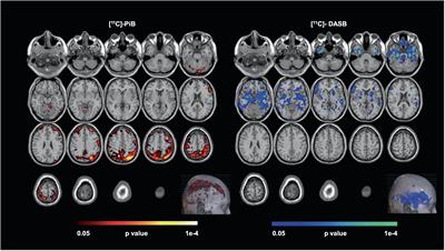 The utility of PET imaging in depression